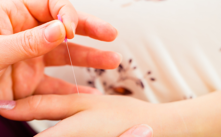 prenatal acupuncture Chicago Family Doulas